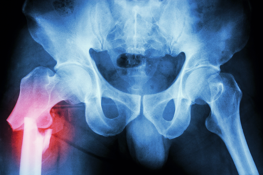 Fracture Right Femur (thigh's Bone)